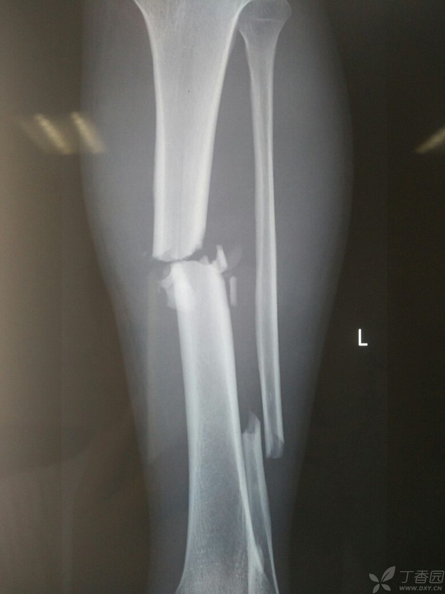 科技重塑脛腓骨骨折康復(fù)之旅，引領(lǐng)未來體驗(yàn)新篇章