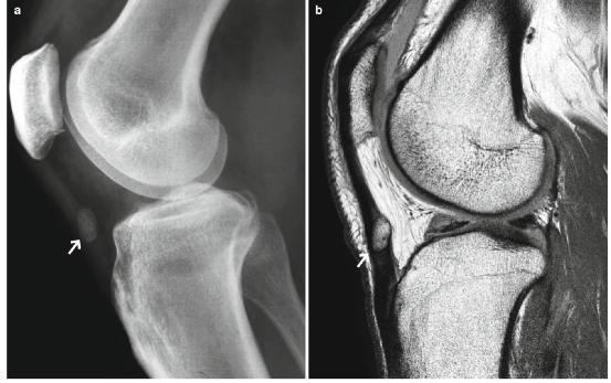 髕腱炎成為醫(yī)學(xué)焦點，從幕后走向舞臺中央的最新進展